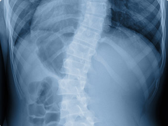 Spine And Scoliosis Disorders