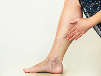 Varicose veins