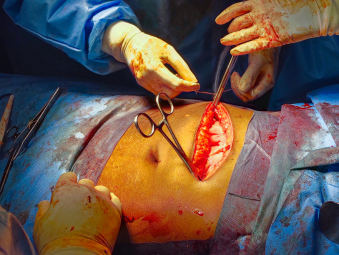 Abdominal Surgery