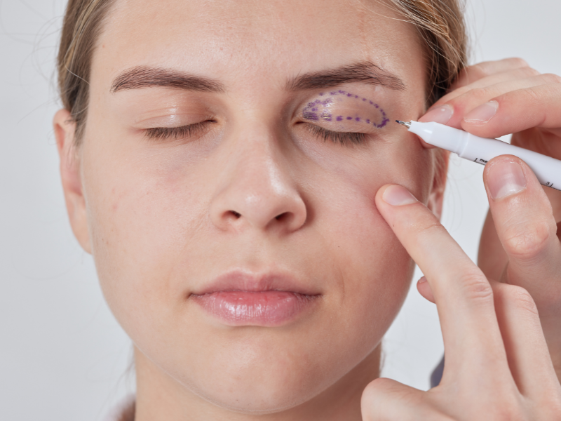 Cosmetic Eyelid Surgery