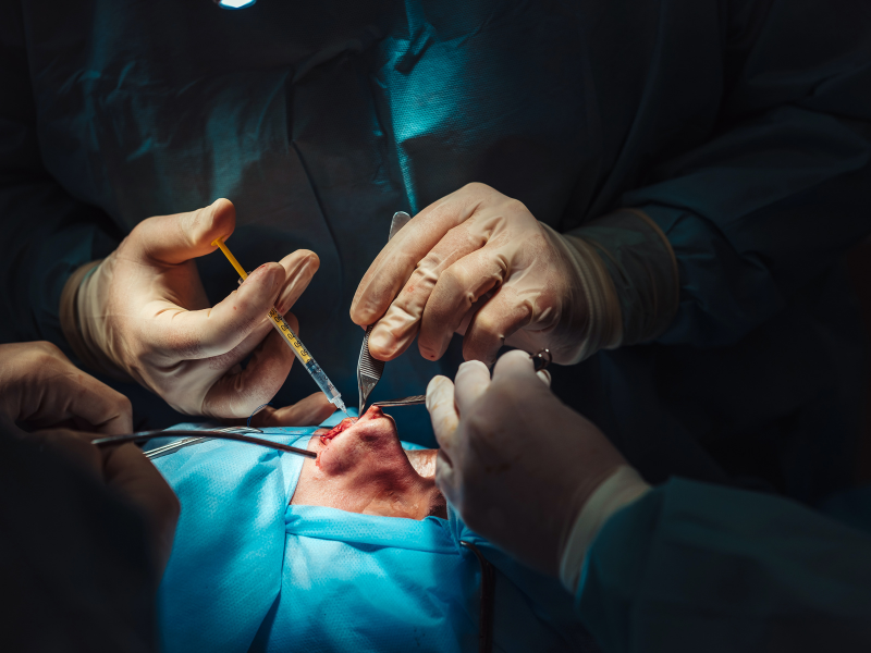 Functional Endoscopic Sinus Surgery